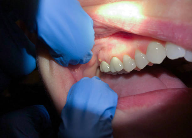 Best Emergency Root Canal Treatment in Pineville, KY