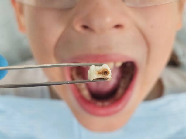 Best Emergency Treatment for Dental Infections or Abscesses in Pineville, KY